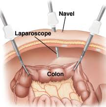Laparoscopic Colectomy
