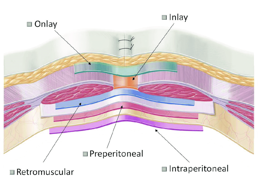 Laparoscopic Ventral Hernia Repair with Composite Mesh